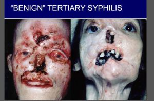 Tertiary syphilis symptoms 960X635 jpeg