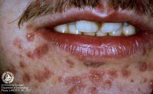 Latent stage syphilis symptoms 725X449 jpeg