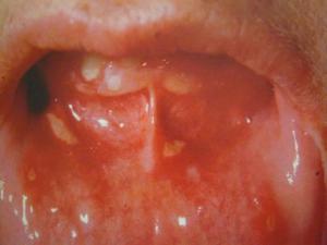 Vaginal aphthous ulcer 638X480 jpeg