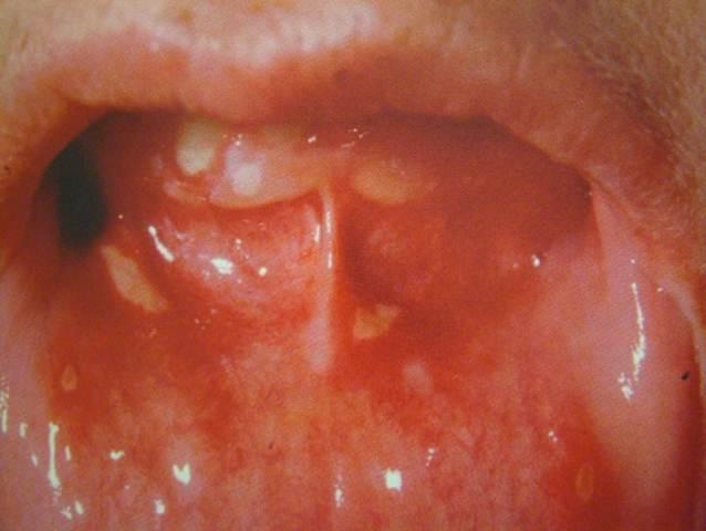 Vaginal aphthous ulcer full size