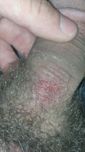 Pimple like bump on penis shaft 960X1703 jpeg
