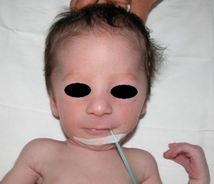 Prader willi syndrome 482X415 jpeg