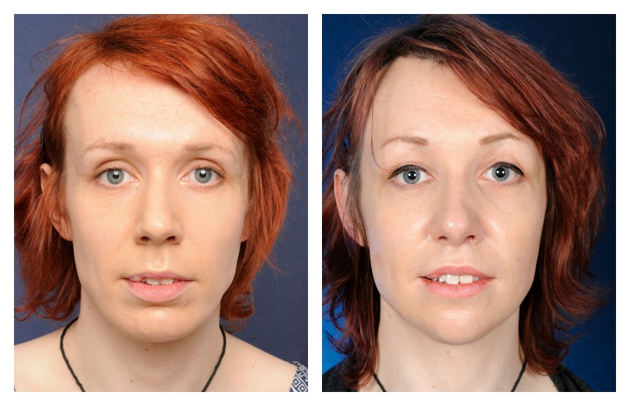 Facial feminization surgery before and after full size