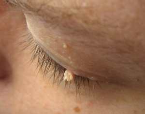 Wart on eyelid 960X758 jpeg