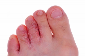 Athletes foot treatment 900X598 jpeg