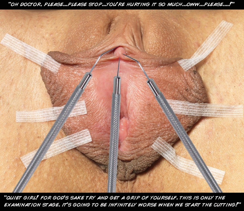 Clitoridectomy female circumcision full size