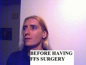Facial feminization surgery 640X480 jpeg