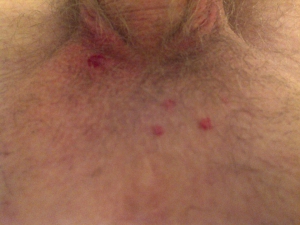 Ingrown hair on pubic area 960X720 jpeg