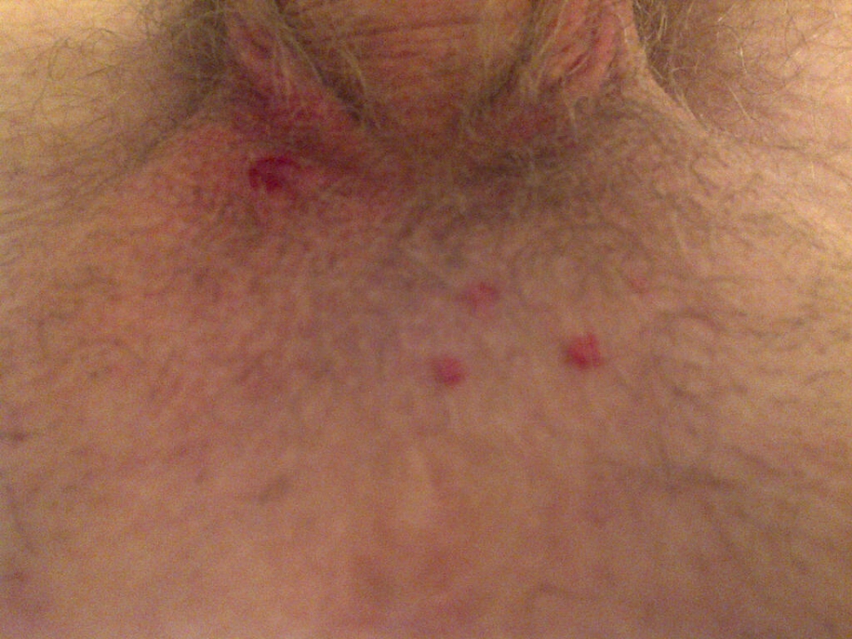 Ingrown hair on pubic area full size