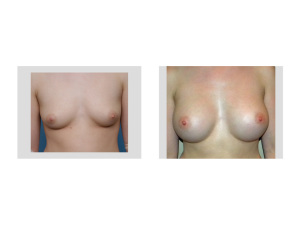 Girls puberty stages breast 960X741 jpeg