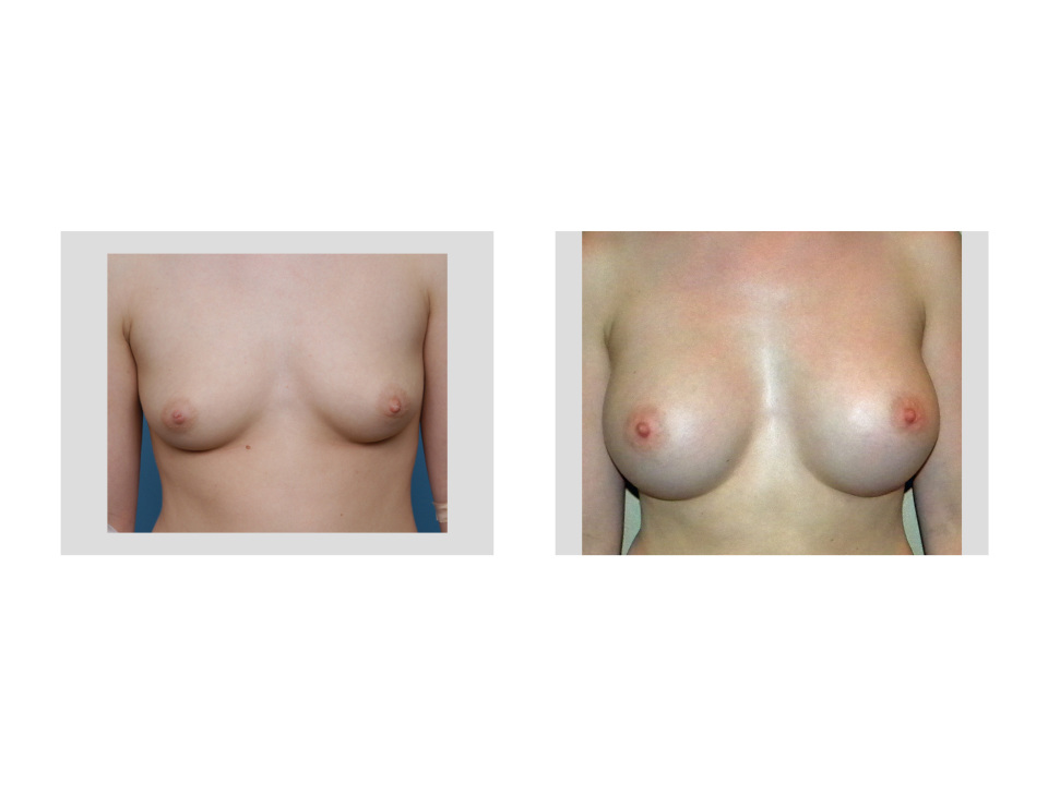 Girls puberty stages breast full size