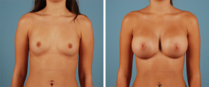 Saline vs silicone breast implants 960X402 jpeg