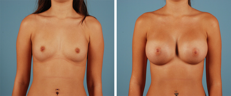 Saline vs silicone breast implants full size